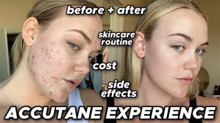 Does Accutane Make You Gain Weight
